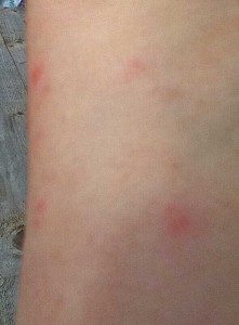 stinging nettles. Image of nettle rash